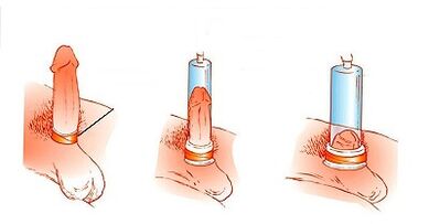 The principle of operation of the pump to enlarge the penis
